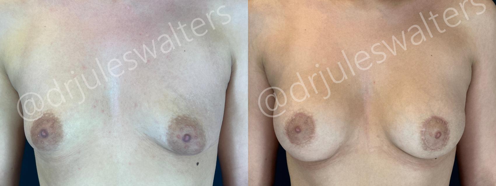 Before & After Breast Augmentation Case 192 Front View in Metairie and New Orleans, LA