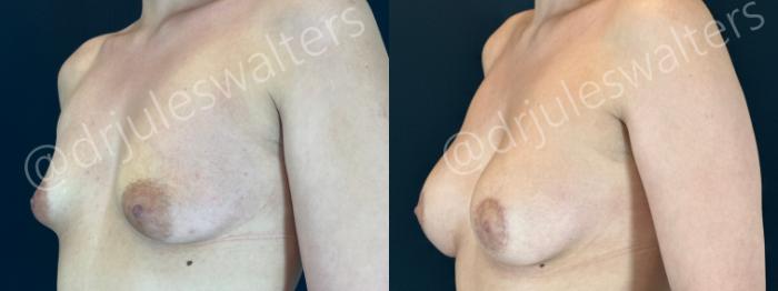 Before & After Breast Augmentation Case 192 Left Oblique View in Metairie and New Orleans, LA