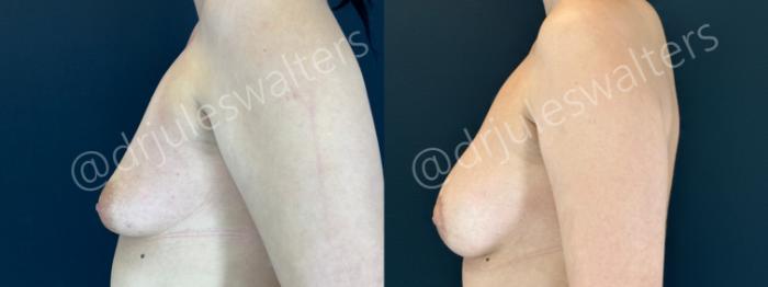 Before & After Breast Augmentation Case 192 Left Side View in Metairie and New Orleans, LA