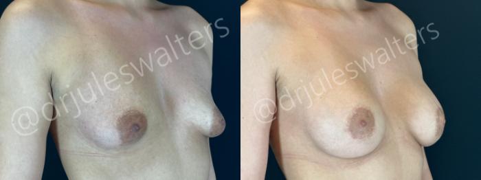 Before & After Breast Augmentation Case 192 Right Oblique View in Metairie and New Orleans, LA