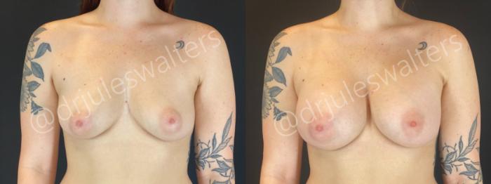 Before & After Breast Augmentation Case 193 Front View in Metairie and New Orleans, LA