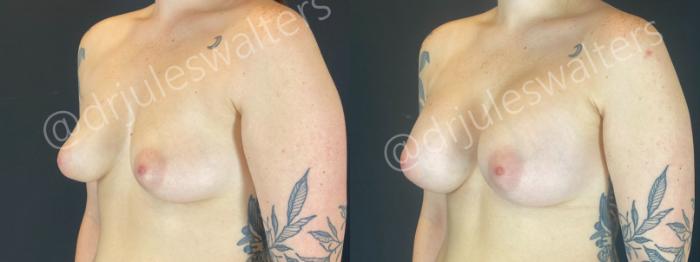 Before & After Breast Augmentation Case 193 Left Oblique View in Metairie and New Orleans, LA