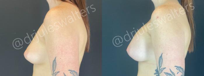 Before & After Breast Augmentation Case 193 Left Side View in Metairie and New Orleans, LA