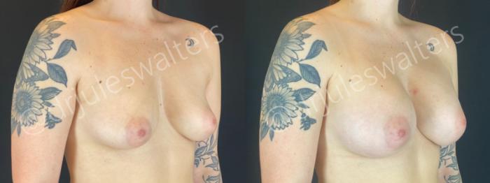 Before & After Breast Augmentation Case 193 Right Oblique View in Metairie and New Orleans, LA