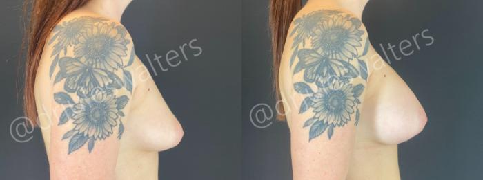 Before & After Breast Augmentation Case 193 Right Side View in Metairie and New Orleans, LA