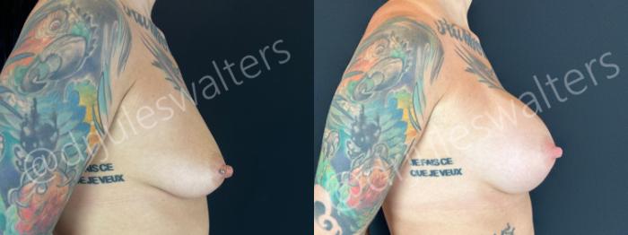 Before & After Breast Augmentation Case 195 Right Side View in Metairie and New Orleans, LA