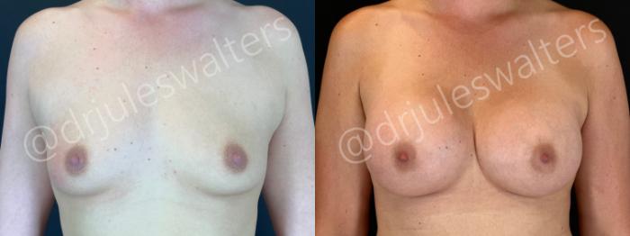 Before & After Breast Augmentation Case 202 Front View in Metairie and New Orleans, LA