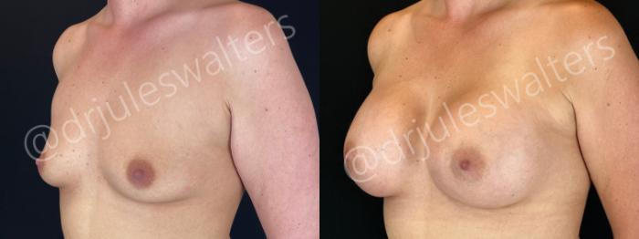 Before & After Breast Augmentation Case 202 Left Oblique View in Metairie and New Orleans, LA