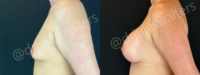 Before & After Breast Augmentation Case 202 Left Side View in Metairie and New Orleans, LA