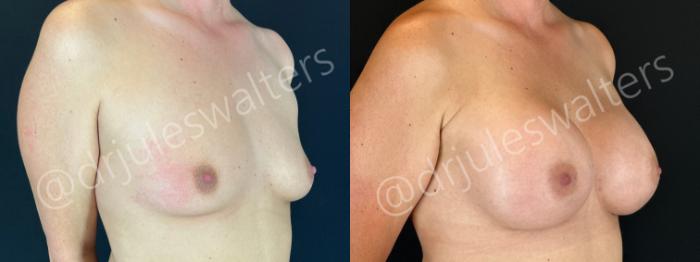 Before & After Breast Augmentation Case 202 Right Oblique View in Metairie and New Orleans, LA