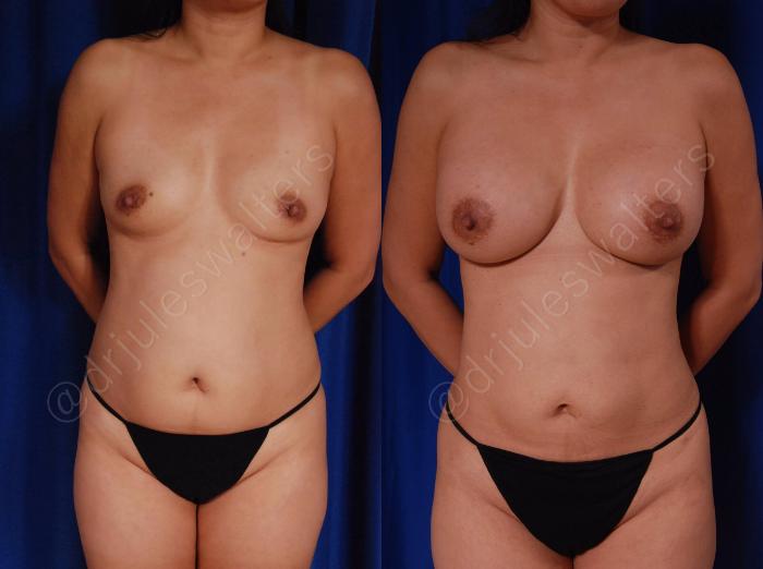 Before & After Breast Augmentation Case 28 View #1 View in Metairie and New Orleans, LA