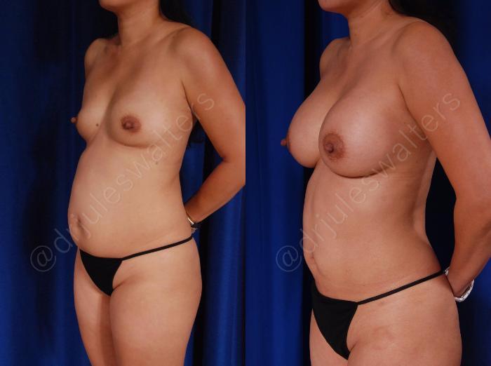 Before & After Breast Augmentation Case 28 View #2 View in Metairie and New Orleans, LA