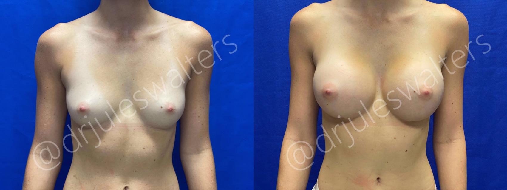 Before & After Breast Augmentation Case 59 View #1 View in Metairie and New Orleans, LA