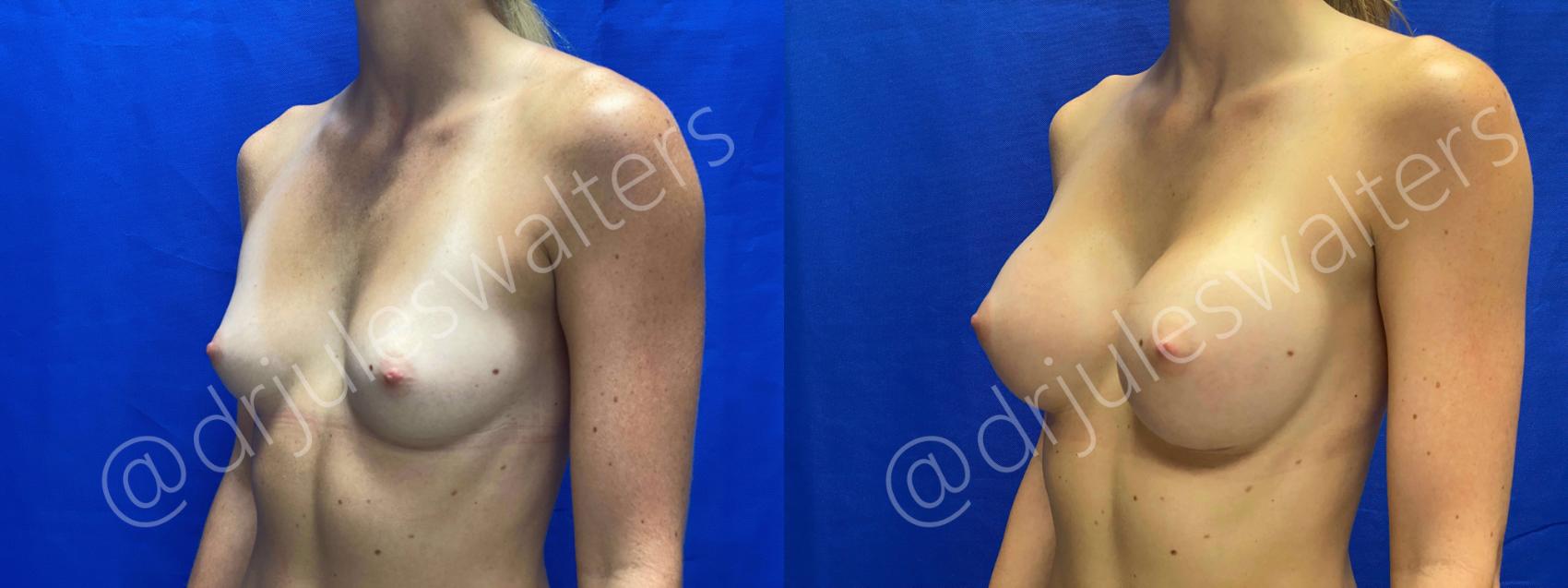 Before & After Breast Augmentation Case 59 View #2 View in Metairie, New Orleans, Covington, LA