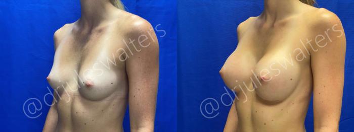 Before & After Breast Augmentation Case 59 View #2 View in Metairie and New Orleans, LA