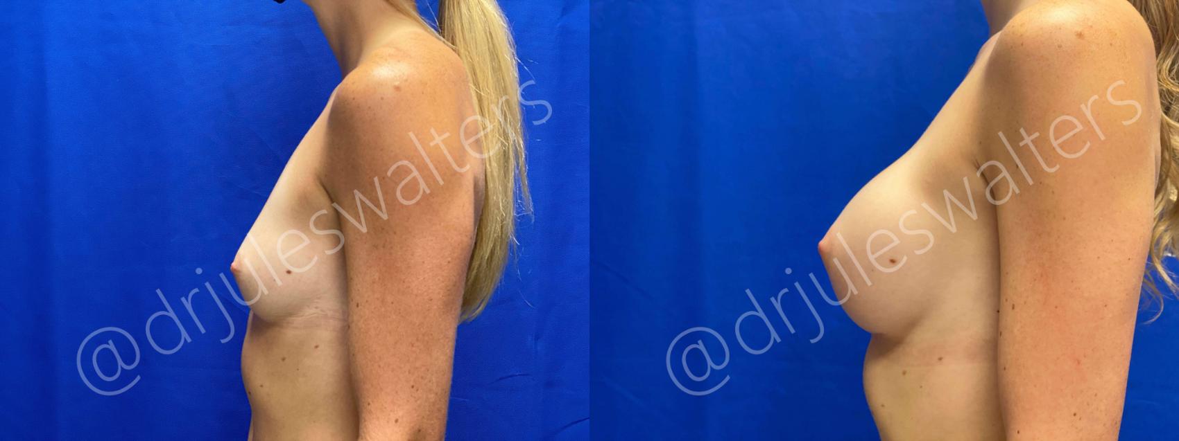 Before & After Breast Augmentation Case 59 View #3 View in Metairie, New Orleans, Covington, LA