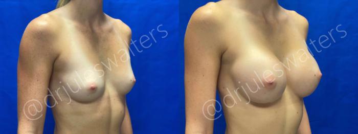 Before & After Breast Augmentation Case 59 View #4 View in Metairie and New Orleans, LA