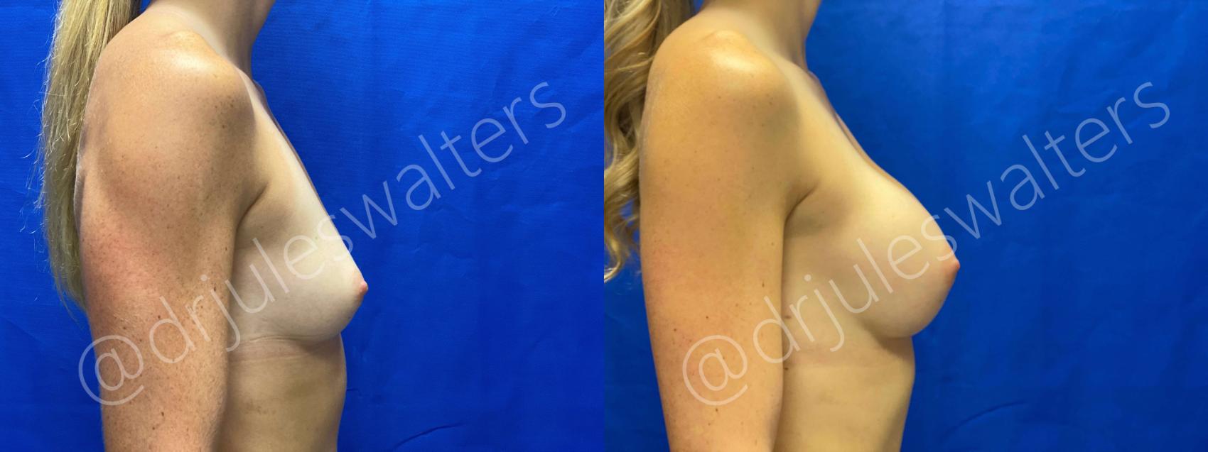 Before & After Breast Augmentation Case 59 View #5 View in Metairie, New Orleans, Covington, LA