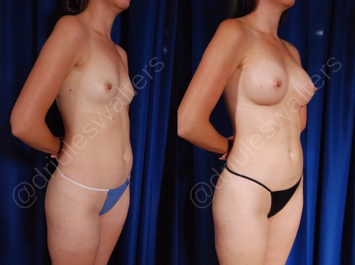 Before & After Breast Augmentation Case 60 View #4 View in Metairie and New Orleans, LA