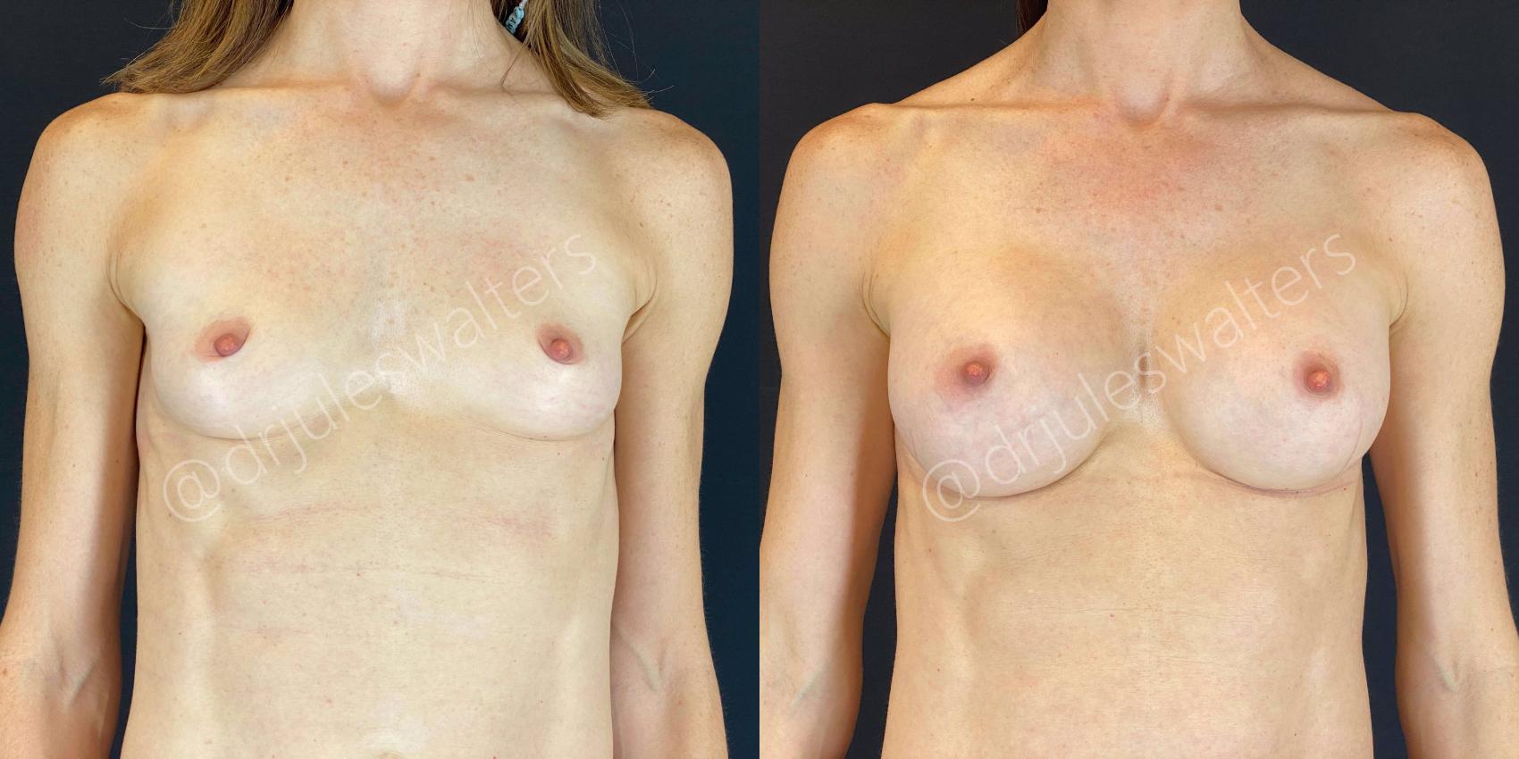 Before & After Breast Augmentation Case 61 View #1 View in Metairie and New Orleans, LA