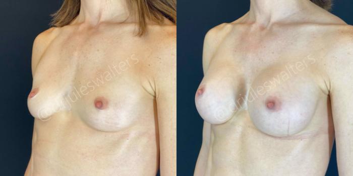 Before & After Breast Augmentation Case 61 View #2 View in Metairie and New Orleans, LA