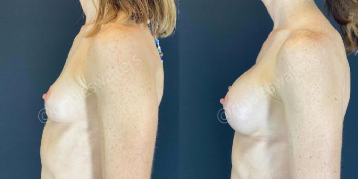 Before & After Breast Augmentation Case 61 View #3 View in Metairie and New Orleans, LA