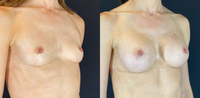 Before & After Breast Augmentation Case 61 View #4 View in Metairie and New Orleans, LA
