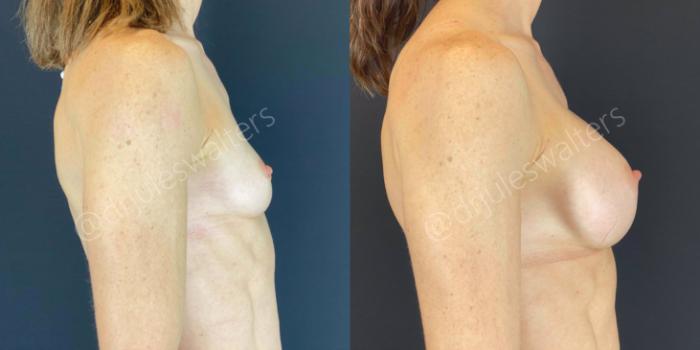 Before & After Breast Augmentation Case 61 View #5 View in Metairie and New Orleans, LA