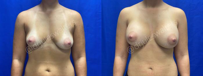 Before & After Breast Augmentation Case 63 View #1 View in Metairie and New Orleans, LA