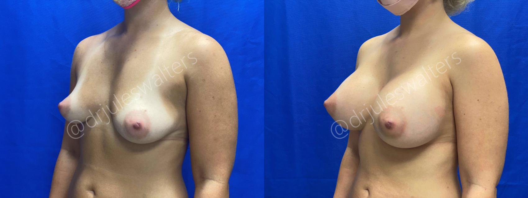 Before & After Breast Augmentation Case 63 View #2 View in Metairie, New Orleans, Covington, LA