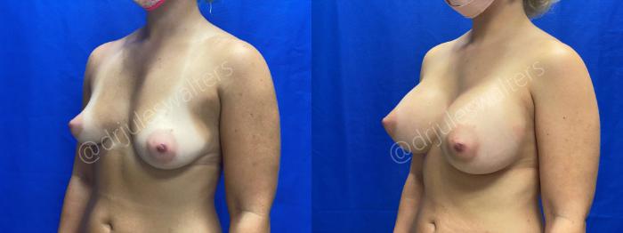 Before & After Breast Augmentation Case 63 View #2 View in Metairie and New Orleans, LA