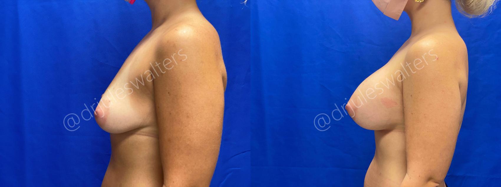 Before & After Breast Augmentation Case 63 View #3 View in Metairie, New Orleans, Covington, LA