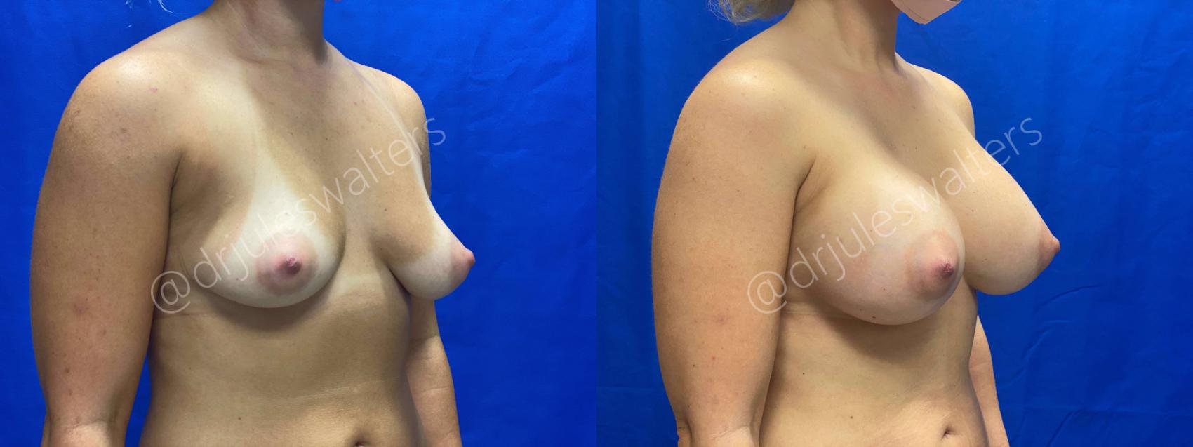 Before & After Breast Augmentation Case 63 View #4 View in Metairie, New Orleans, Covington, LA