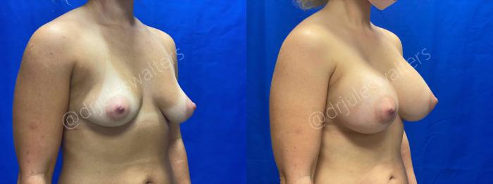 Before & After Breast Augmentation Case 63 View #4 View in Metairie and New Orleans, LA