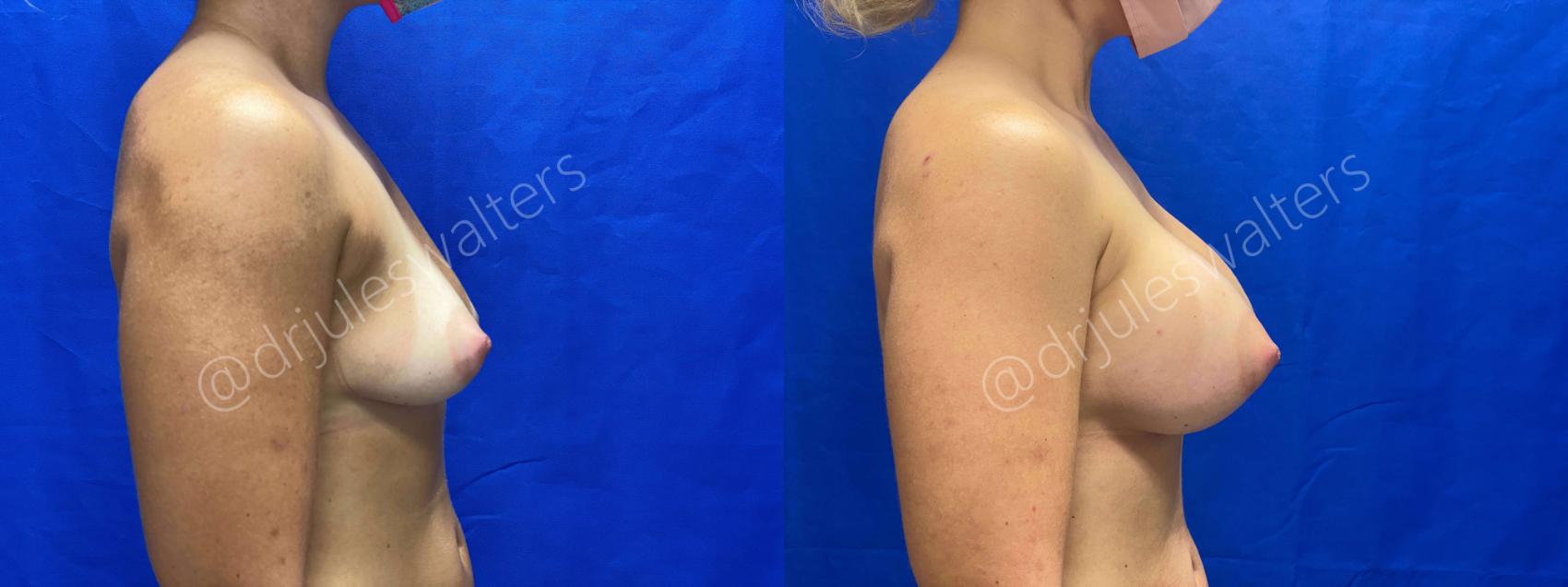 Before & After Breast Augmentation Case 63 View #5 View in Metairie, New Orleans, Covington, LA