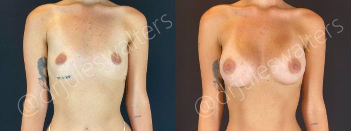 Before & After Breast Augmentation Case 64 View #1 View in Metairie and New Orleans, LA