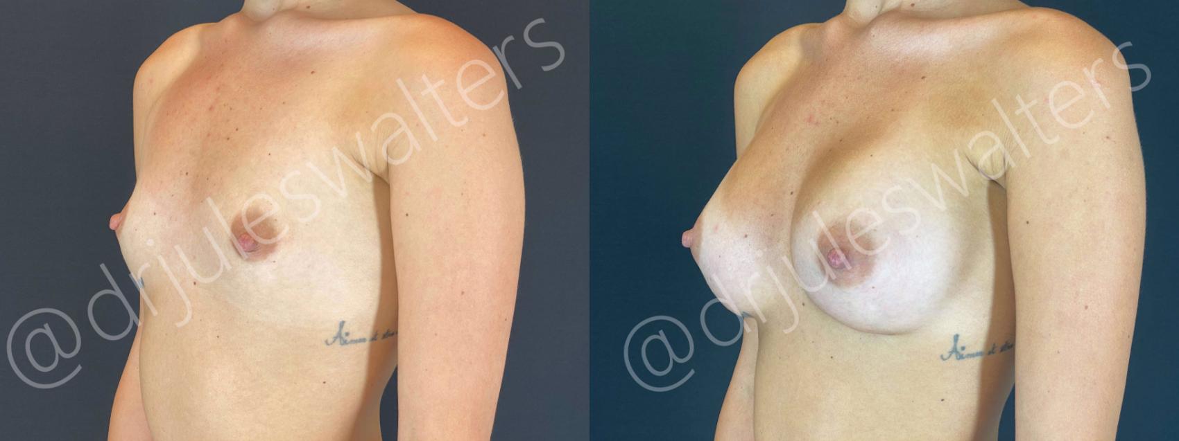 Before & After Breast Augmentation Case 64 View #2 View in Metairie, New Orleans, Covington, LA