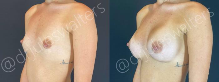 Before & After Breast Augmentation Case 64 View #2 View in Metairie and New Orleans, LA