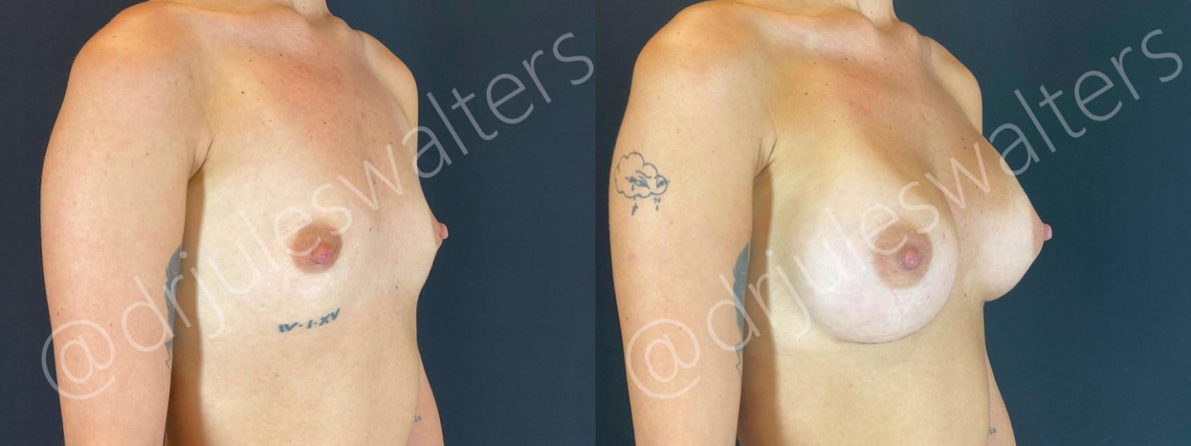 Before & After Breast Augmentation Case 64 View #4 View in Metairie, New Orleans, Covington, LA
