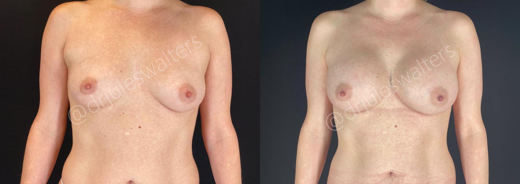 Before & After Breast Augmentation Case 65 View #1 View in Metairie, New Orleans, Covington, LA