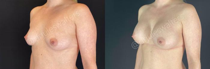 Before & After Breast Augmentation Case 65 View #3 View in Metairie and New Orleans, LA