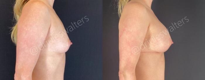 Before & After Breast Augmentation Case 65 View #4 View in Metairie and New Orleans, LA