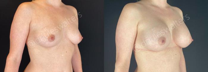 Before & After Breast Augmentation Case 65 View #5 View in Metairie and New Orleans, LA