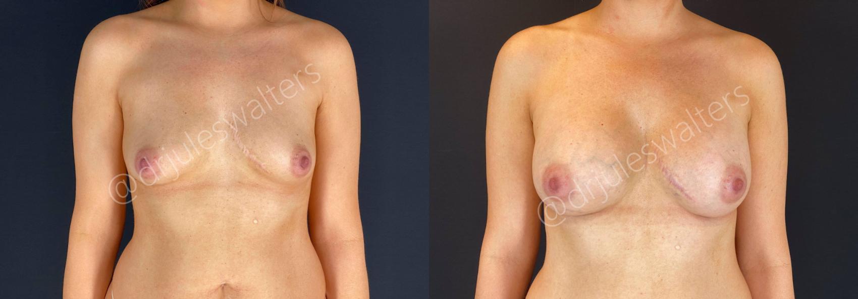Before & After Breast Augmentation Case 66 View #1 View in Metairie, New Orleans, Covington, LA