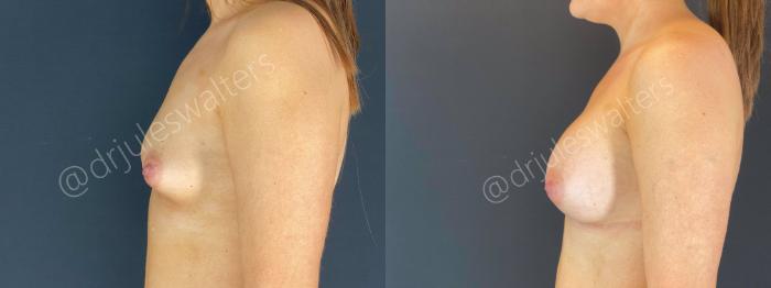 Before & After Breast Augmentation Case 66 View #2 View in Metairie and New Orleans, LA