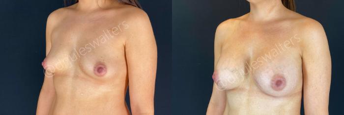 Before & After Breast Augmentation Case 66 View #3 View in Metairie and New Orleans, LA