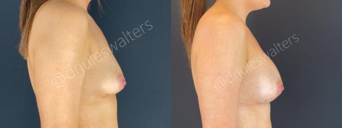 Before & After Breast Augmentation Case 66 View #4 View in Metairie and New Orleans, LA