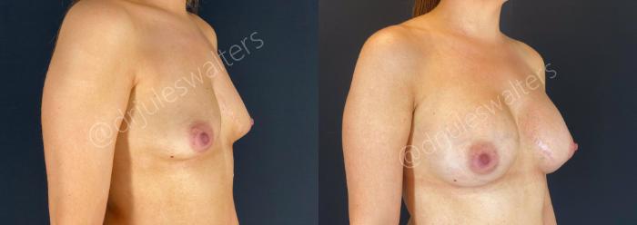 Before & After Breast Augmentation Case 66 View #5 View in Metairie and New Orleans, LA