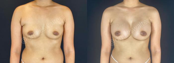 Before & After Breast Augmentation Case 67 View #1 View in Metairie and New Orleans, LA