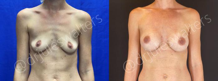 Before & After Breast Augmentation Case 68 View #1 View in Metairie and New Orleans, LA